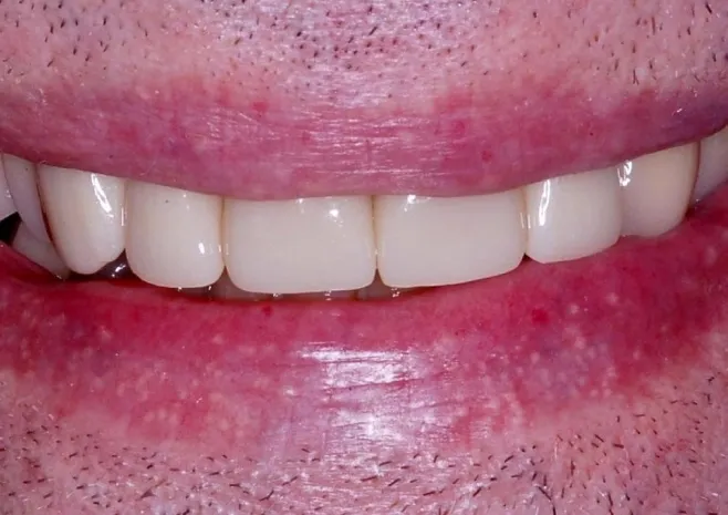 Smile transformation after