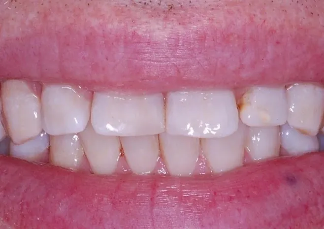 Smile transformation after