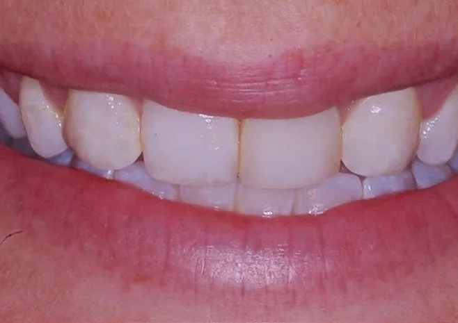 Smile transformation before