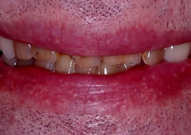 Smile transformation before