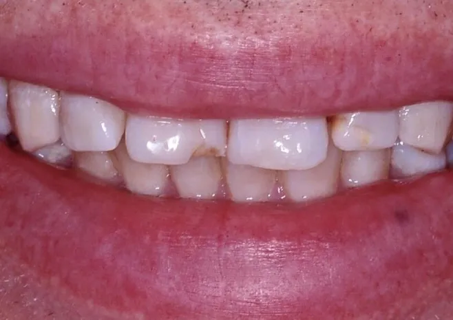 Smile transformation before