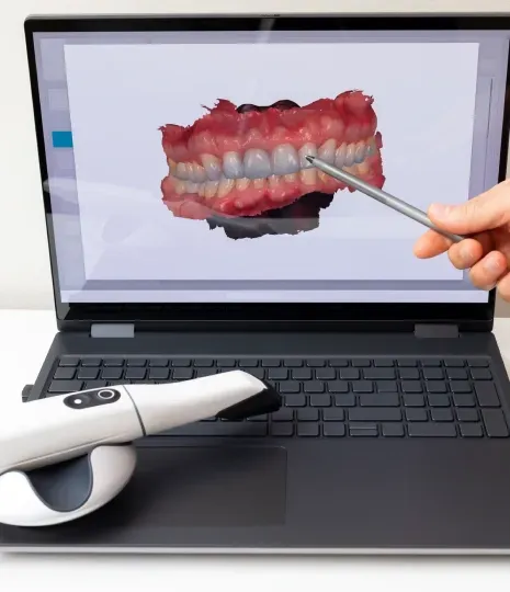 Laptop screen showing a 3D dental scan with a hand-held intraoral scanner nearby
