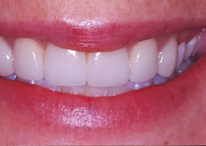 After: close-up of upper and lower teeth showing white front dental crowns