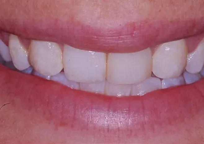 Before: close-up of upper and lower teeth with visible gumline, gaps, and discoloration