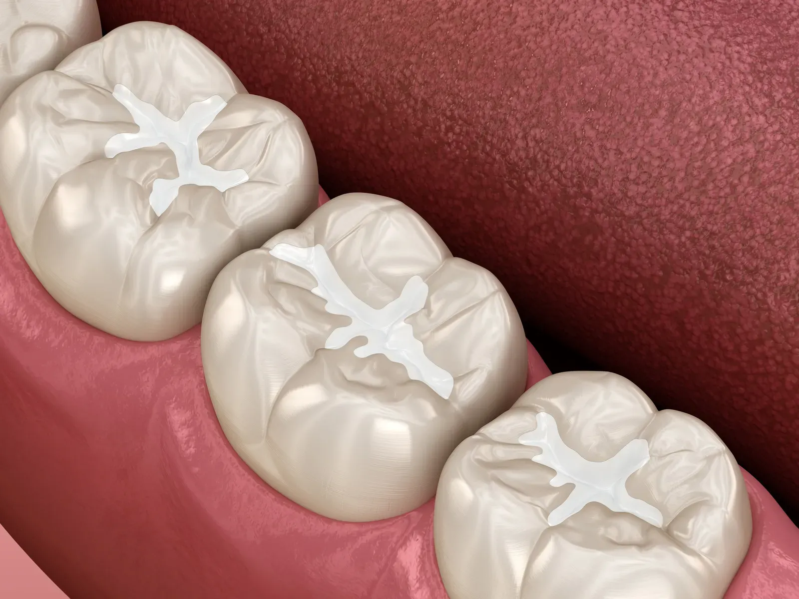 Dental Sealants at Drewyer Dentistry Burtonsville